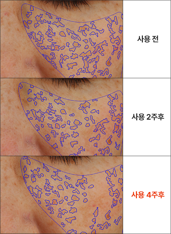 <p>Hiệu quả cải thiện tuyệt vời đối với tàn nhang, ngay cả những tàn nhang đã xuất hiện trong thời gian dài</p>
